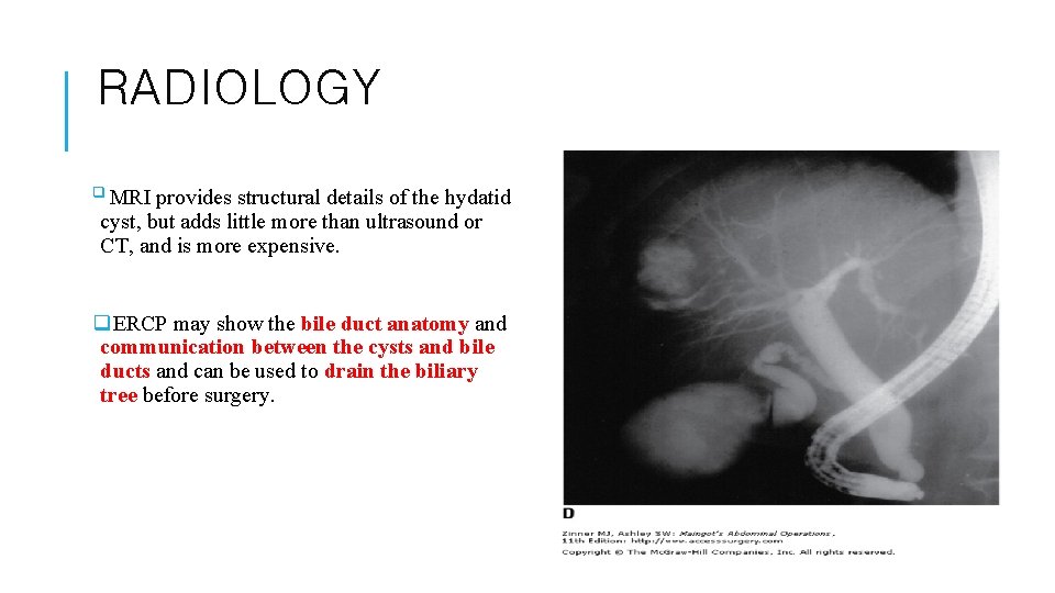 RADIOLOGY q MRI provides structural details of the hydatid cyst, but adds little more