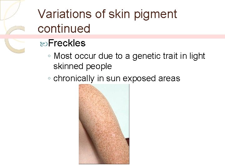 Variations of skin pigment continued Freckles ◦ Most occur due to a genetic trait