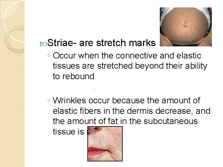  Striae- are stretch marks ◦ Occur when the connective and elastic tissues are