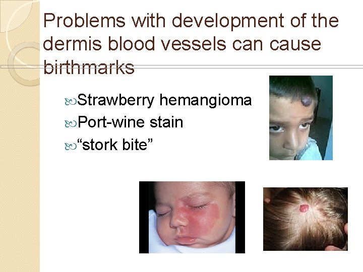 Problems with development of the dermis blood vessels can cause birthmarks Strawberry hemangioma Port-wine