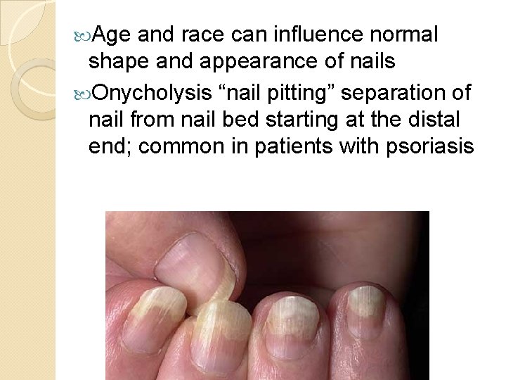  Age and race can influence normal shape and appearance of nails Onycholysis “nail