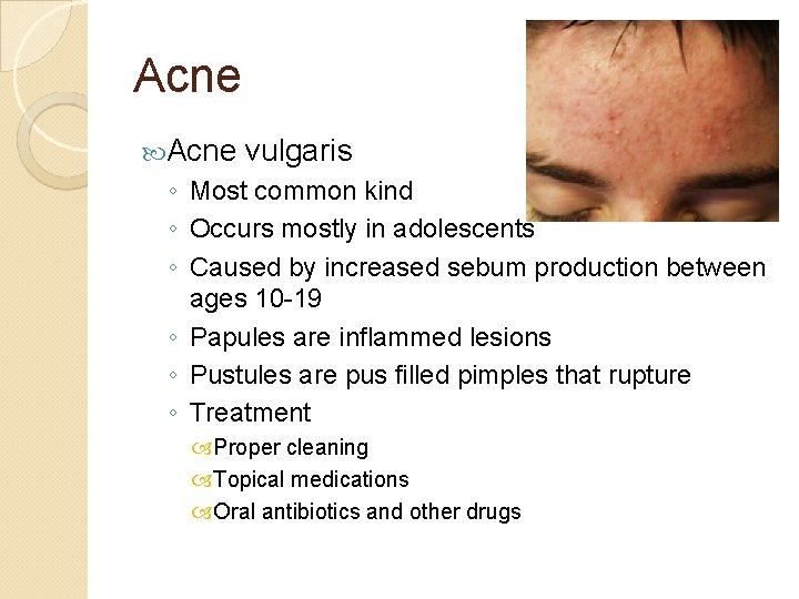 Acne vulgaris ◦ Most common kind ◦ Occurs mostly in adolescents ◦ Caused by