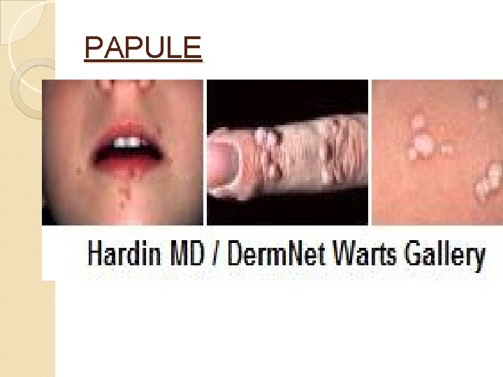 PAPULE 