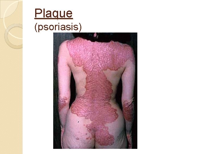 Plaque (psoriasis) 