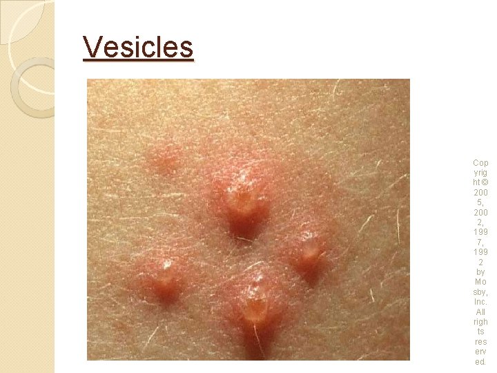 Vesicles Cop yrig ht © 200 5, 200 2, 199 7, 199 2 by
