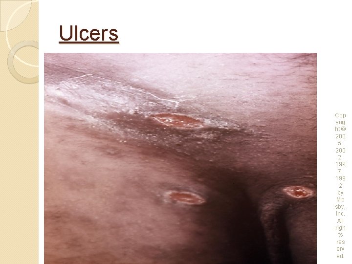 Ulcers Cop yrig ht © 200 5, 200 2, 199 7, 199 2 by