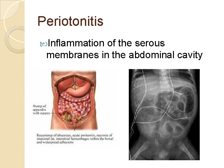 Periotonitis Inflammation of the serous membranes in the abdominal cavity 