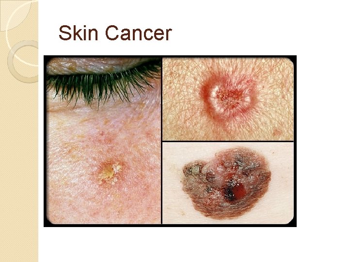 Skin Cancer 