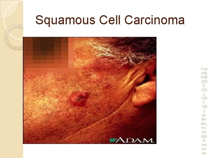 Squamous Cell Carcinoma Cop yrig ht © 200 5, 200 2, 199 7, 199