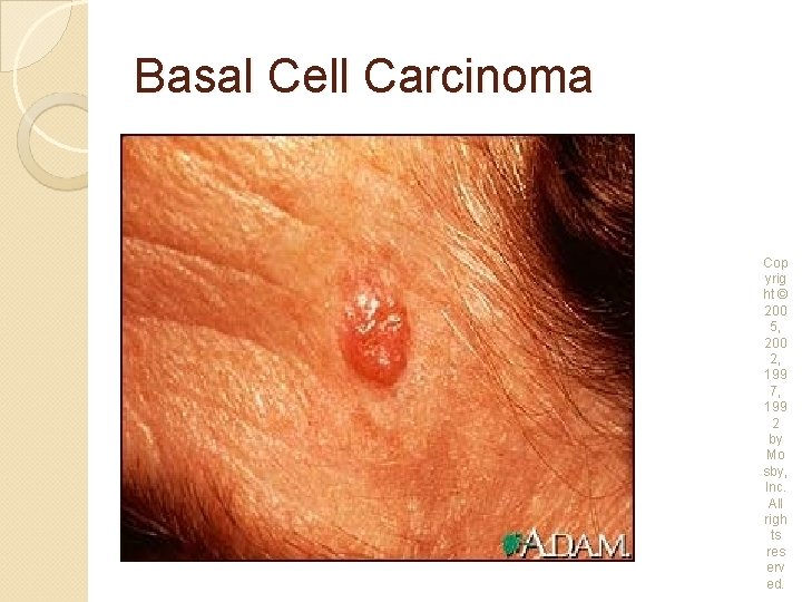 Basal Cell Carcinoma Cop yrig ht © 200 5, 200 2, 199 7, 199