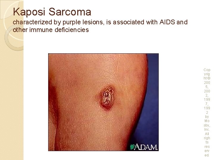 Kaposi Sarcoma characterized by purple lesions, is associated with AIDS and other immune deficiencies