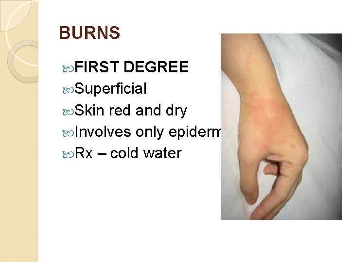 BURNS FIRST DEGREE Superficial Skin red and dry Involves only epidermis Rx – cold