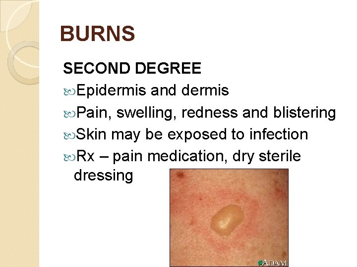 BURNS SECOND DEGREE Epidermis and dermis Pain, swelling, redness and blistering Skin may be