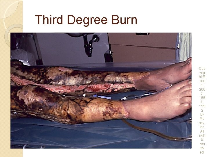 Third Degree Burn Cop yrig ht © 200 5, 200 2, 199 7, 199