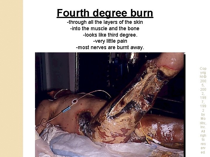 Fourth degree burn -through all the layers of the skin -into the muscle and