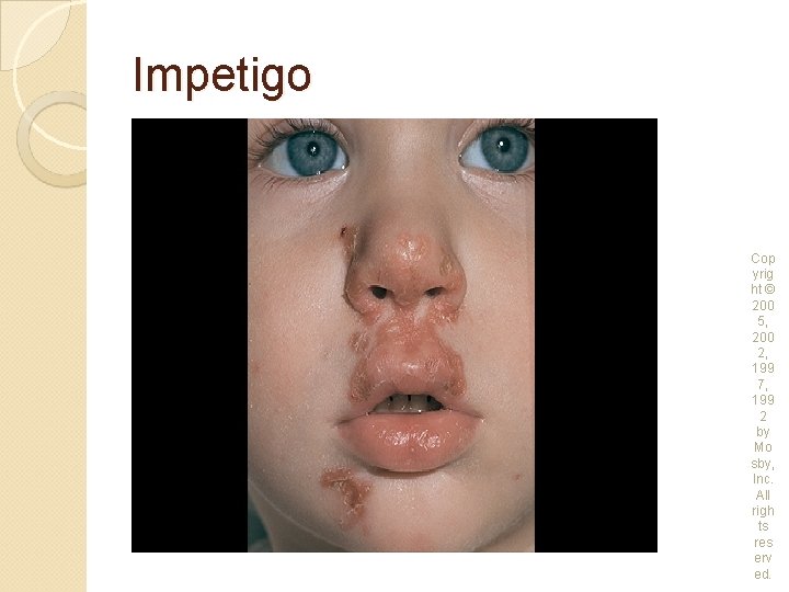 Impetigo Cop yrig ht © 200 5, 200 2, 199 7, 199 2 by