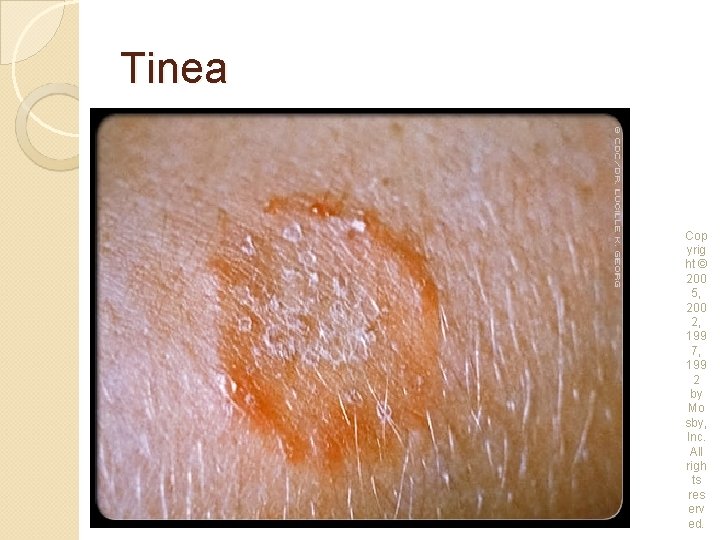 Tinea Cop yrig ht © 200 5, 200 2, 199 7, 199 2 by