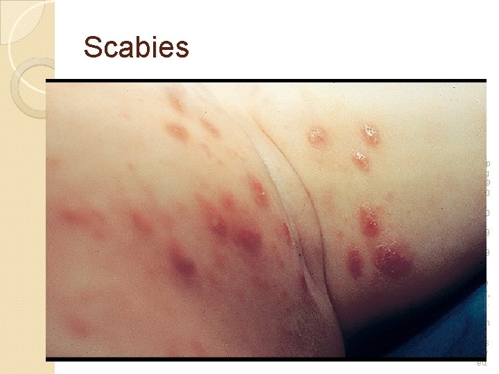 Scabies Cop yrig ht © 200 5, 200 2, 199 7, 199 2 by