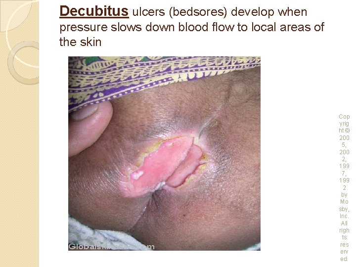 Decubitus ulcers (bedsores) develop when pressure slows down blood flow to local areas of