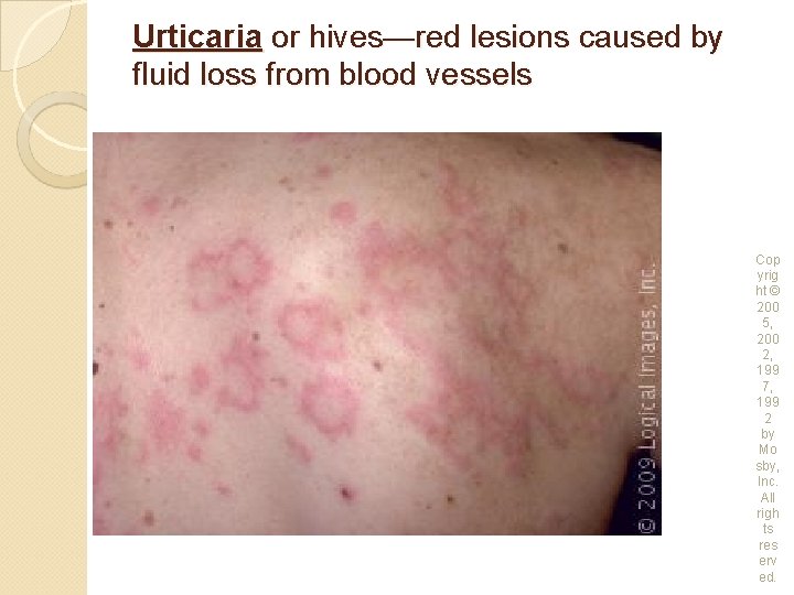 Urticaria or hives—red lesions caused by fluid loss from blood vessels Cop yrig ht