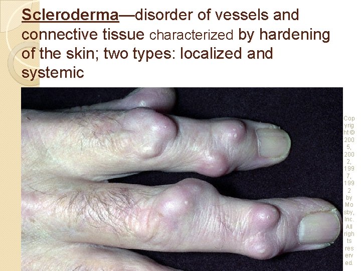 Scleroderma—disorder of vessels and connective tissue characterized by hardening of the skin; two types: