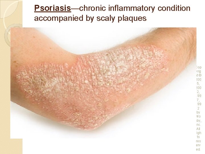 Psoriasis—chronic inflammatory condition accompanied by scaly plaques Cop yrig ht © 200 5, 200