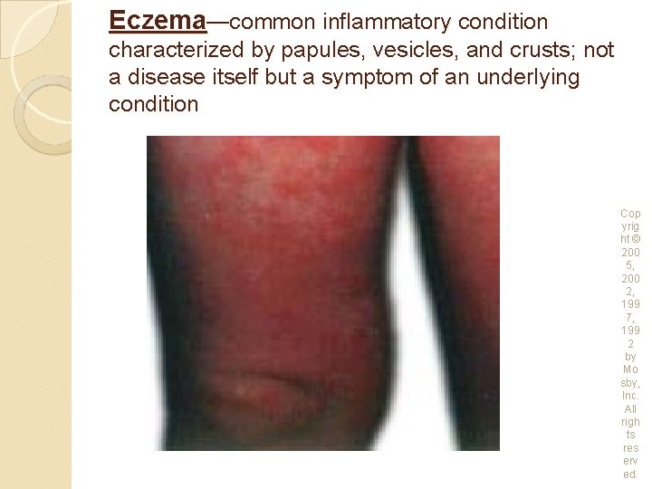 Eczema—common inflammatory condition characterized by papules, vesicles, and crusts; not a disease itself but