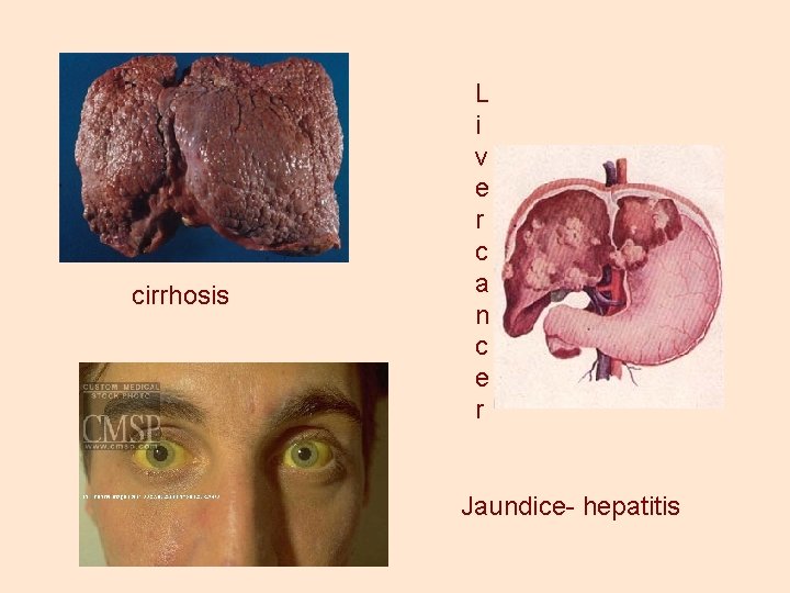 cirrhosis L i v e r c a n c e r Jaundice- hepatitis