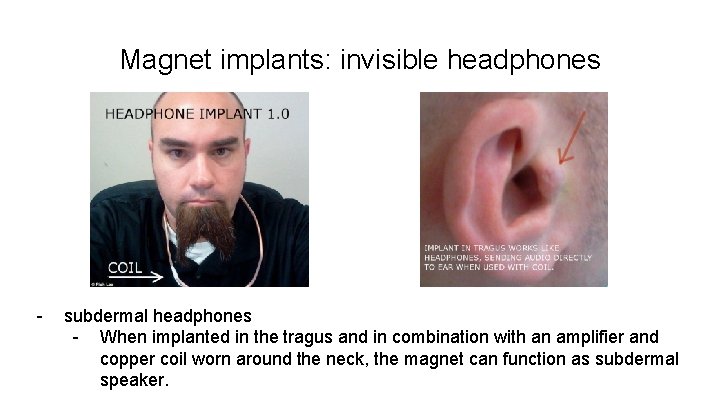 Magnet implants: invisible headphones - subdermal headphones - When implanted in the tragus and