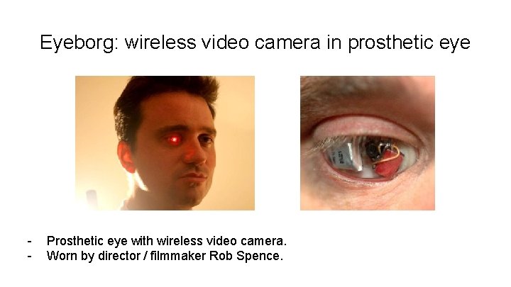 Eyeborg: wireless video camera in prosthetic eye - Prosthetic eye with wireless video camera.
