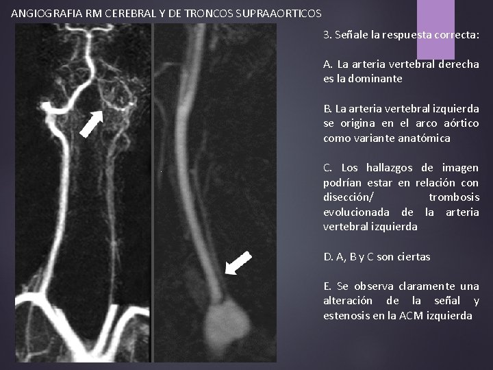 ANGIOGRAFIA RM CEREBRAL Y DE TRONCOS SUPRAAORTICOS 3. Señale la respuesta correcta: A. La