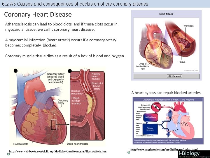 6. 2. A 3 Causes and consequences of occlusion of the coronary arteries. 
