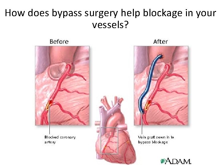 How does bypass surgery help blockage in your vessels? 