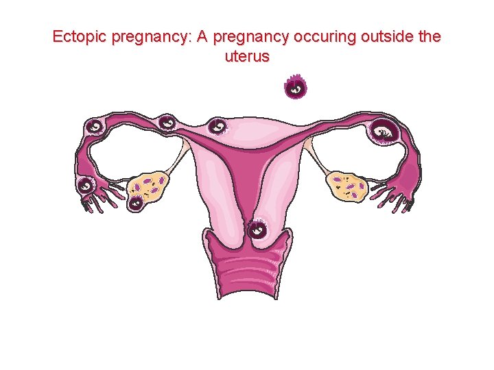 Ectopic pregnancy: A pregnancy occuring outside the uterus 