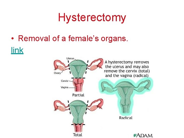 Hysterectomy • Removal of a female’s organs. link 