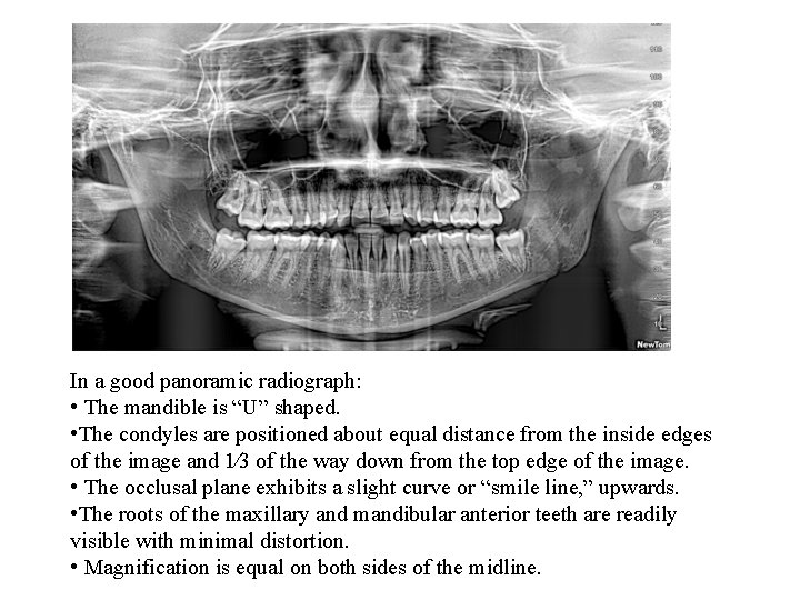 In a good panoramic radiograph: • The mandible is “U” shaped. • The condyles In a good panoramic radiograph: • The mandible is “U” shaped. • The condyles