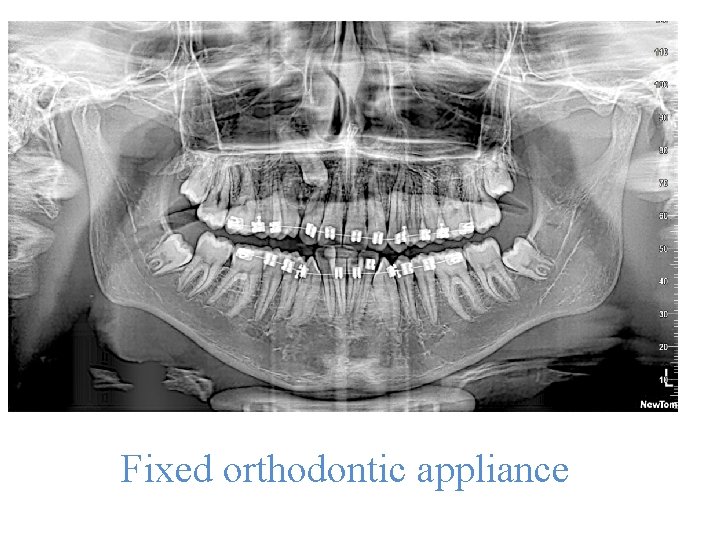 Fixed orthodontic appliance Fixed orthodontic appliance