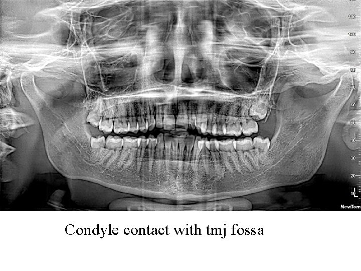 Condyle contact with tmj fossa Condyle contact with tmj fossa