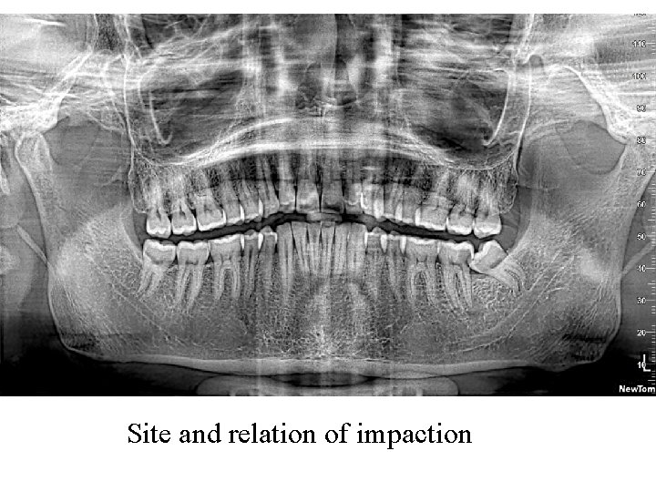 Site and relation of impaction Site and relation of impaction