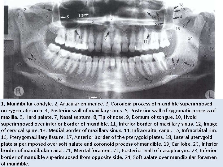 1, Mandibular condyle. 2, Articular eminence. 3, Coronoid process of mandible superimposed on zygomatic 1, Mandibular condyle. 2, Articular eminence. 3, Coronoid process of mandible superimposed on zygomatic