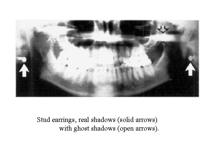 Stud earrings, real shadows (solid arrows) with ghost shadows (open arrows). Stud earrings, real shadows (solid arrows) with ghost shadows (open arrows).