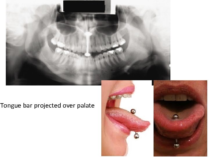 Tongue bar projected over palate Tongue bar projected over palate