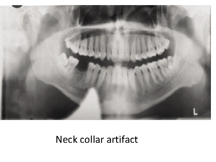 Neck collar artifact Neck collar artifact