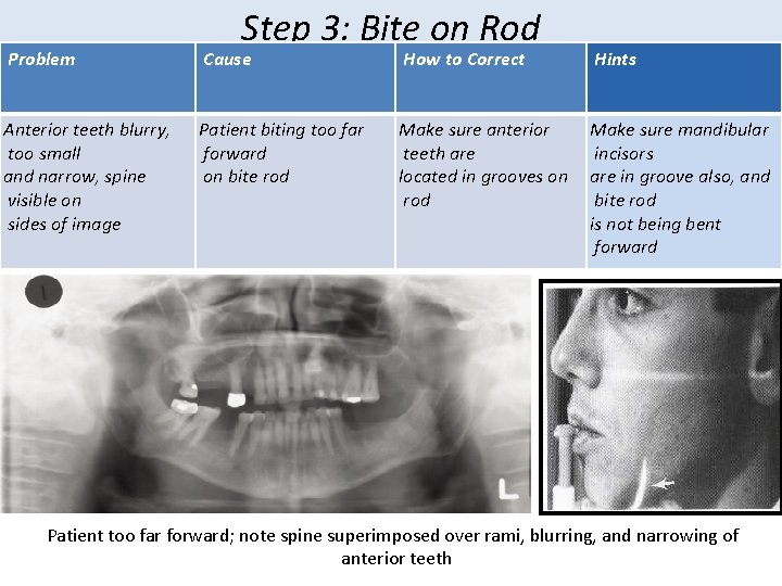 Step 3: Bite on Rod Problem Cause How to Correct Hints Anterior teeth blurry, Step 3: Bite on Rod Problem Cause How to Correct Hints Anterior teeth blurry,