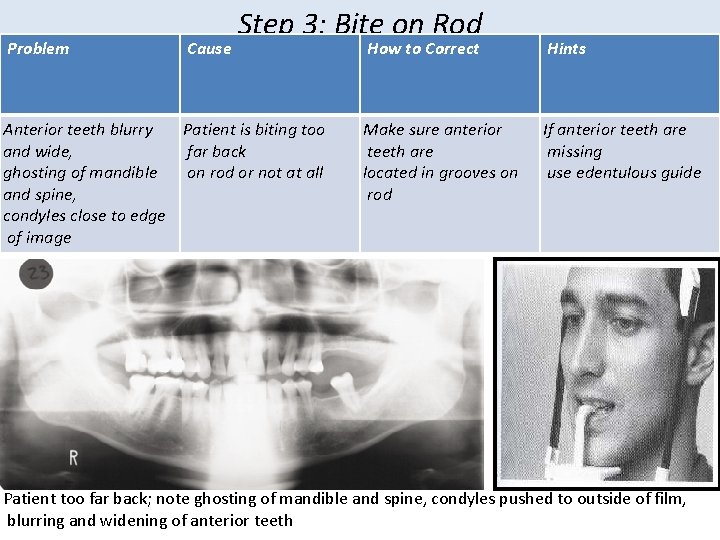 Problem Cause Step 3: Bite on Rod Anterior teeth blurry Patient is biting too Problem Cause Step 3: Bite on Rod Anterior teeth blurry Patient is biting too