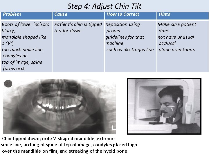 Problem Cause Step 4: Adjust Chin Tilt Roots of lower incisors Patient’s chin is Problem Cause Step 4: Adjust Chin Tilt Roots of lower incisors Patient’s chin is