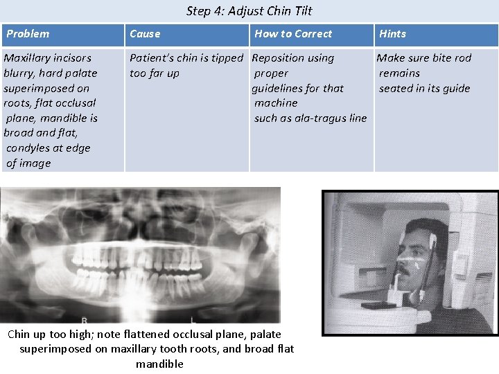 Step 4: Adjust Chin Tilt Problem Cause How to Correct Maxillary incisors blurry, hard Step 4: Adjust Chin Tilt Problem Cause How to Correct Maxillary incisors blurry, hard