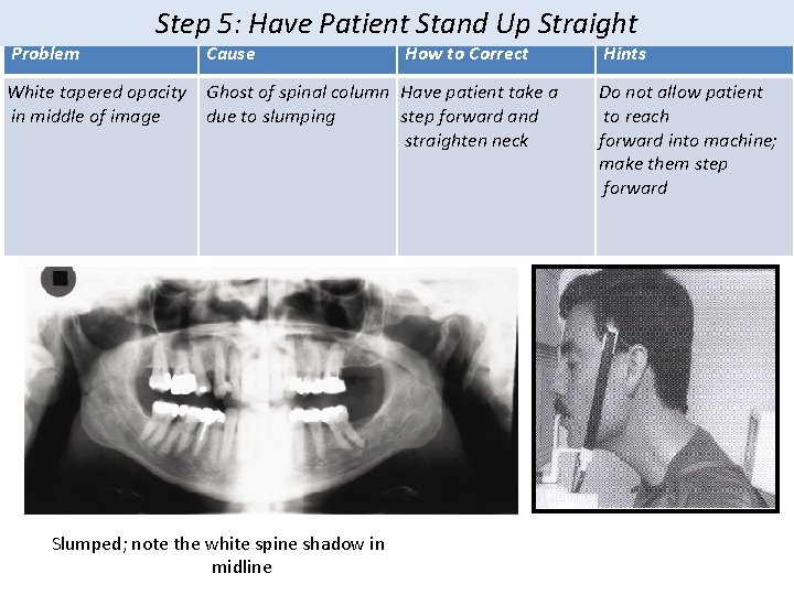 Problem Step 5: Have Patient Stand Up Straight White tapered opacity in middle of Problem Step 5: Have Patient Stand Up Straight White tapered opacity in middle of