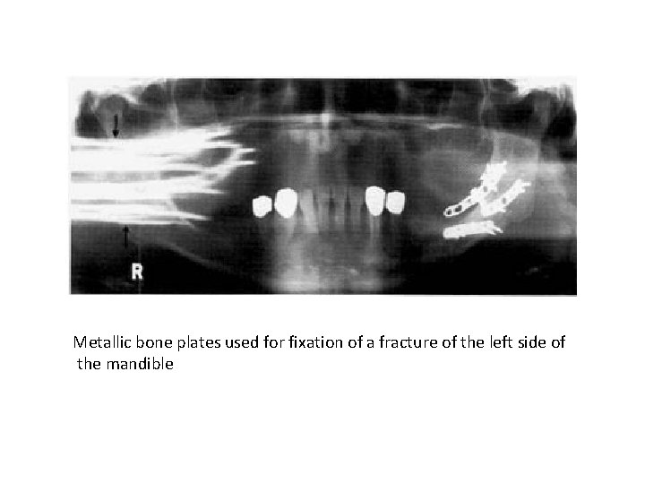 Metallic bone plates used for fixation of a fracture of the left side of Metallic bone plates used for fixation of a fracture of the left side of