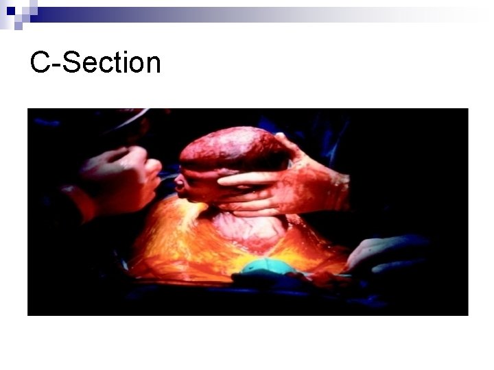 C-Section 